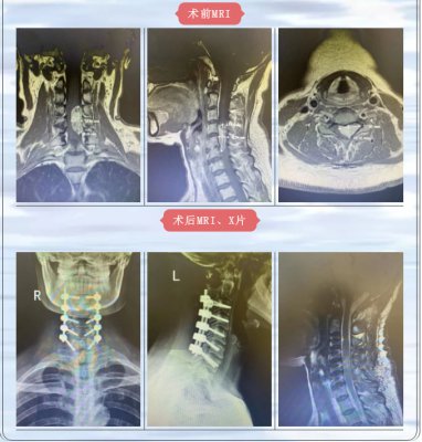 点赞！德宏友谊医院成功完成两例椎管内肿瘤切除术